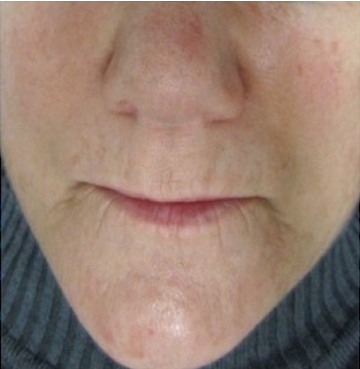 Before and after comparison of skin tightening effects using Procell Microchanneling.
