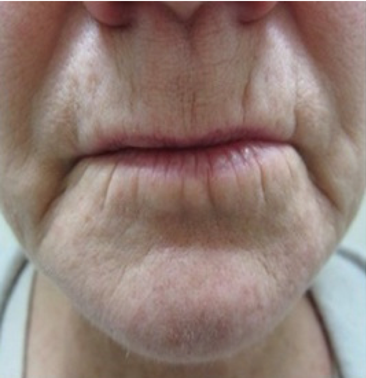 Before and after comparison of skin tightening effects using Procell Microchanneling.
