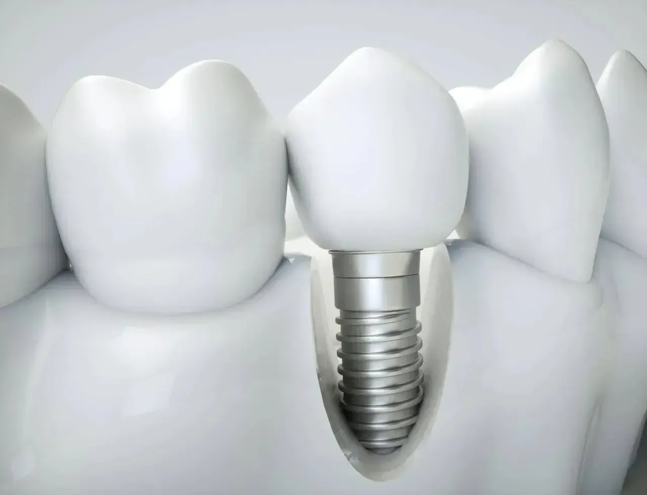 A model of a tooth with a dental implant in it.