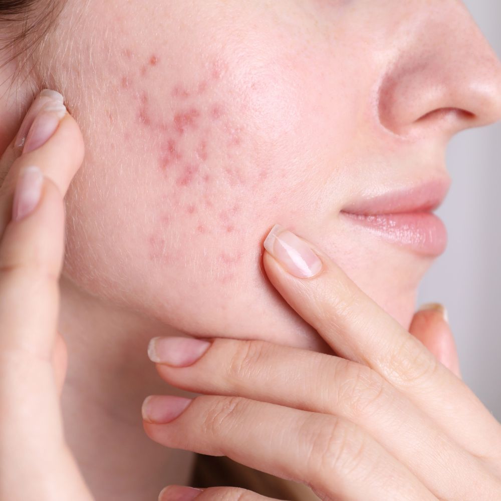 Textured acne scarring on the cheek being examined under clinical lighting