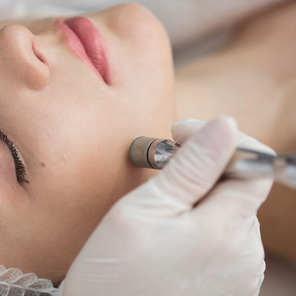 Patient skin looking smooth and refreshed after a microdermabrasion session