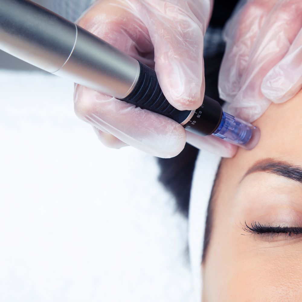 Patient resting after a microneedling session with skin lightly flushed