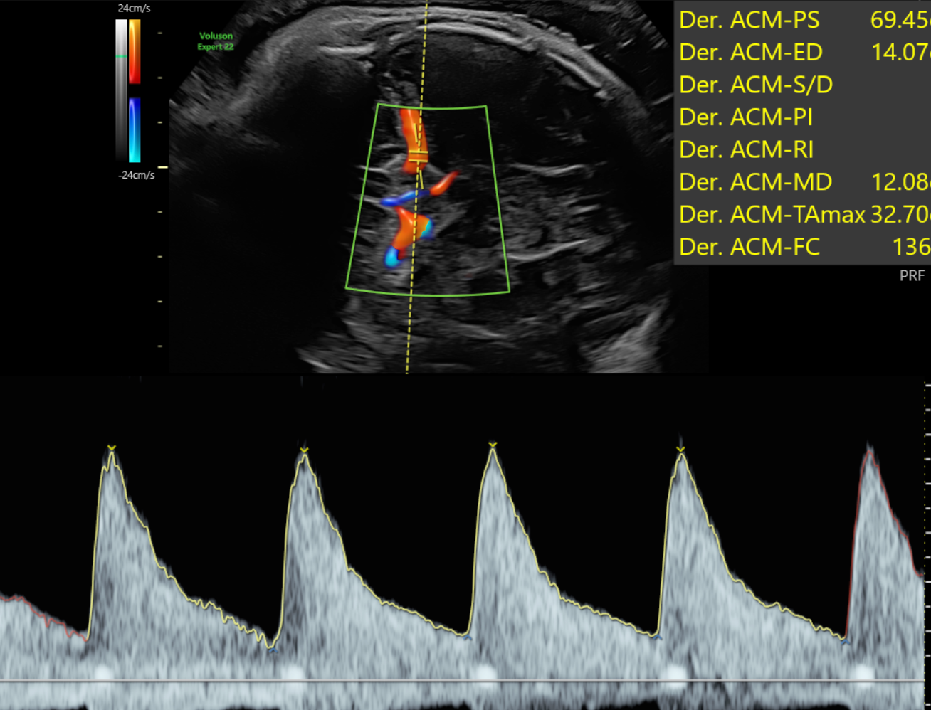 Doppler de la Arteria Cerebral Media  del cerebro fetal que muestra el flujo sanguíneo. 
