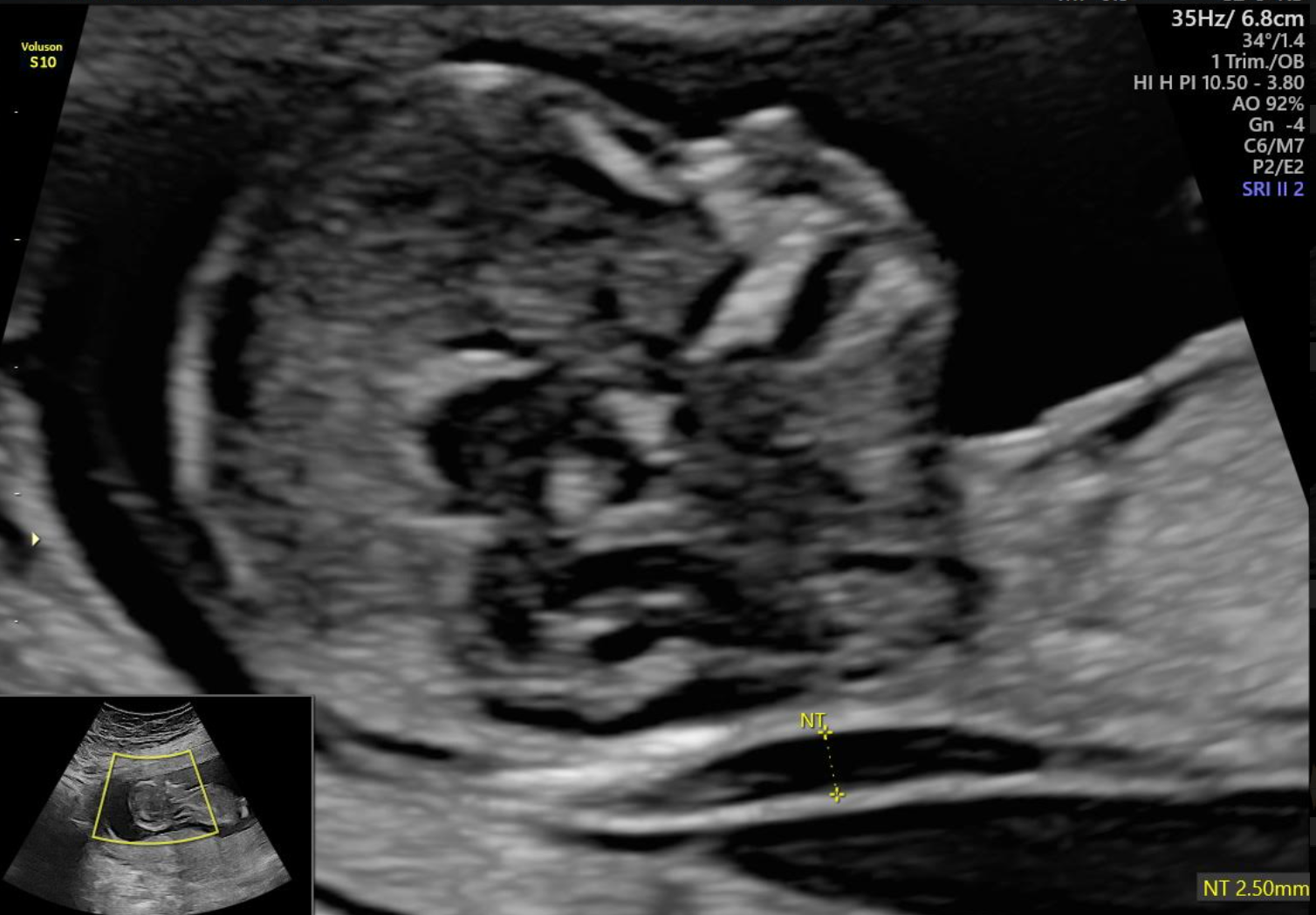 Ecografía fetal en escala de grises; sección transversal de la cabeza y la parte superior del cuerpo de un feto.