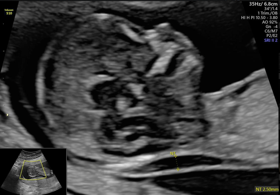 Ecografía fetal en escala de grises; sección transversal de la cabeza y la parte superior del cuerpo de un feto.