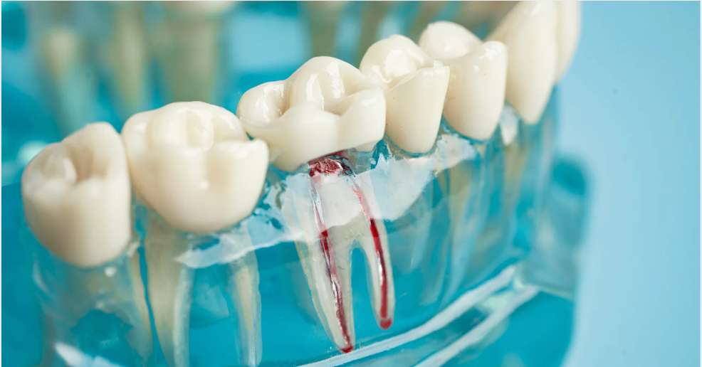 Are Root Canals Safe or Risky?
