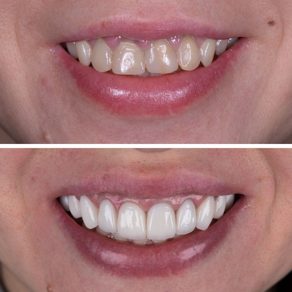 An image showing before and after veneers
