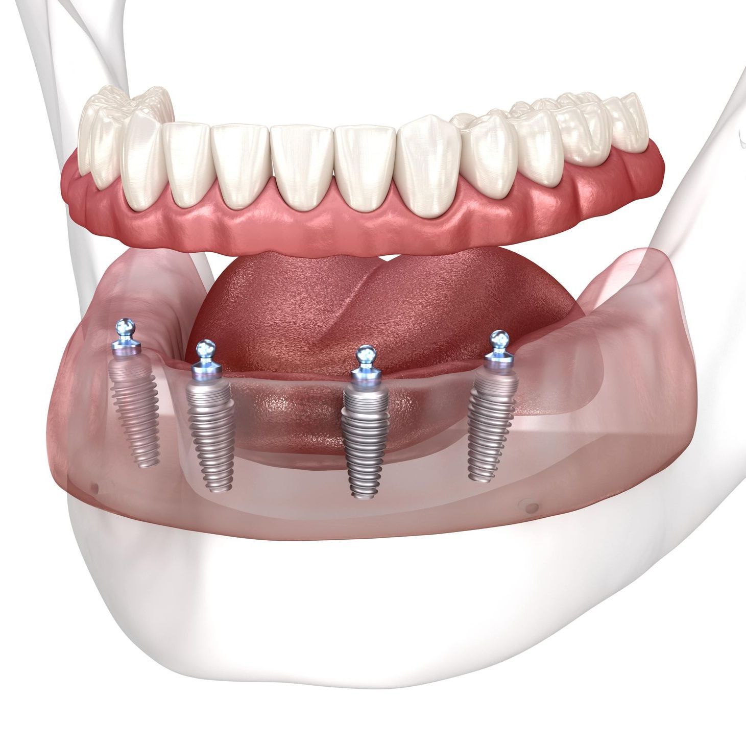 A computer generated image of an all-on-4 full arch replacement