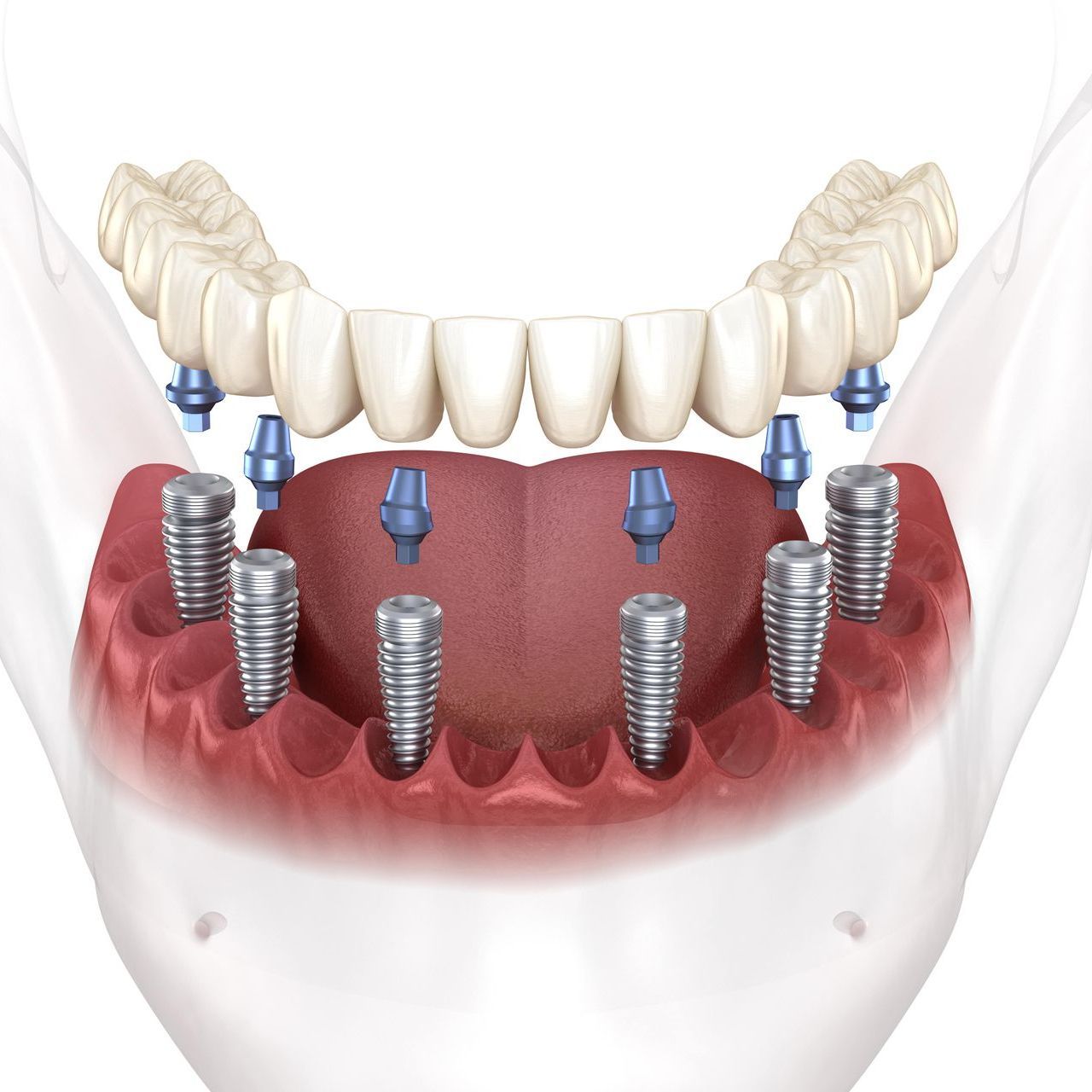 A computer generated image of an all-on-6 full arch replacement