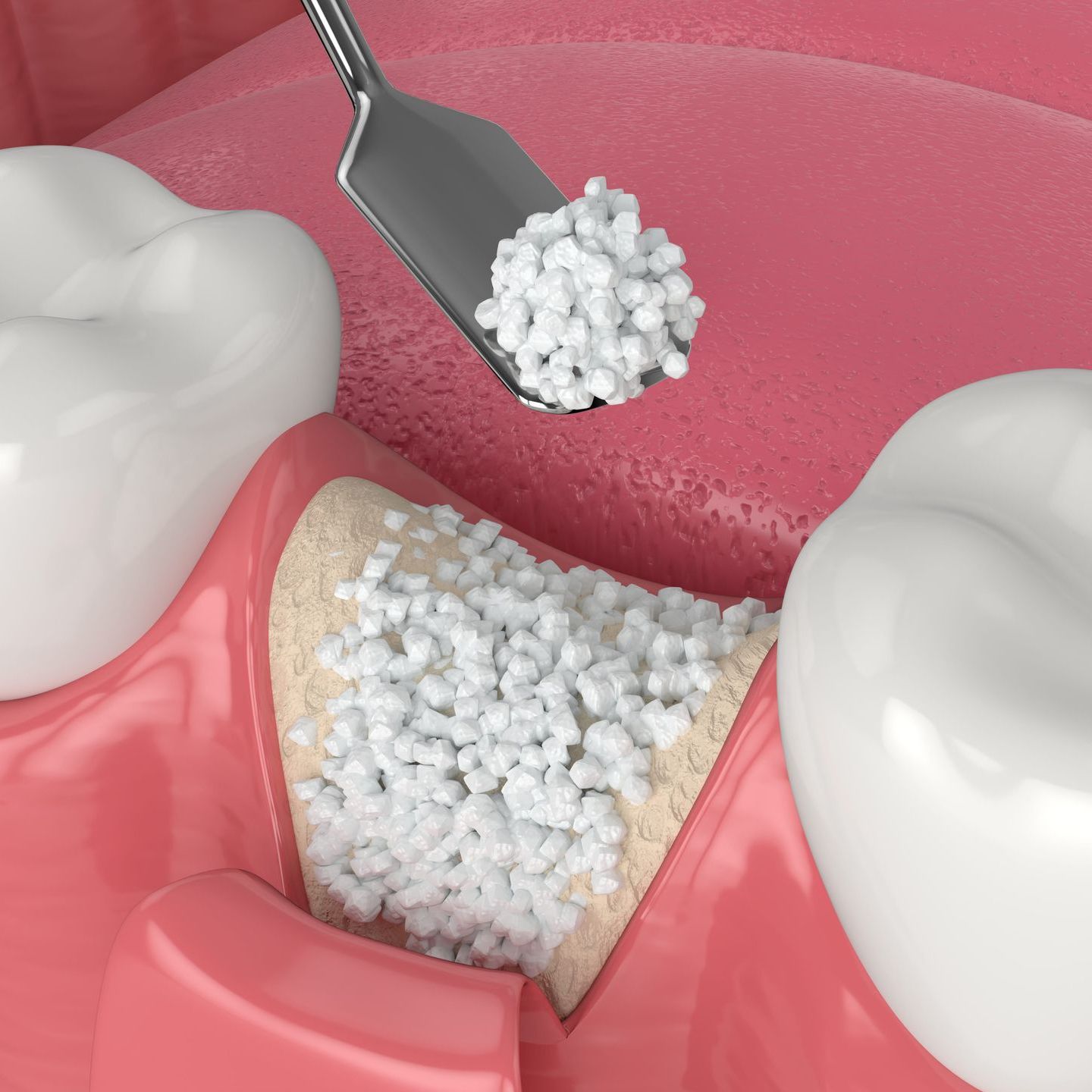 A computer generated image of grafting material being added to the space in between two teeth
