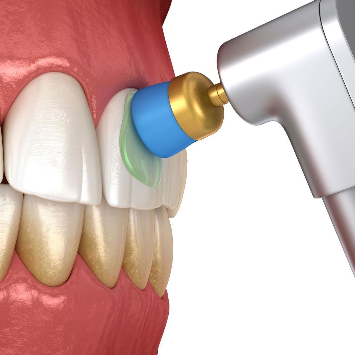 A computer generated image of teeth being cleaned by a professional tool