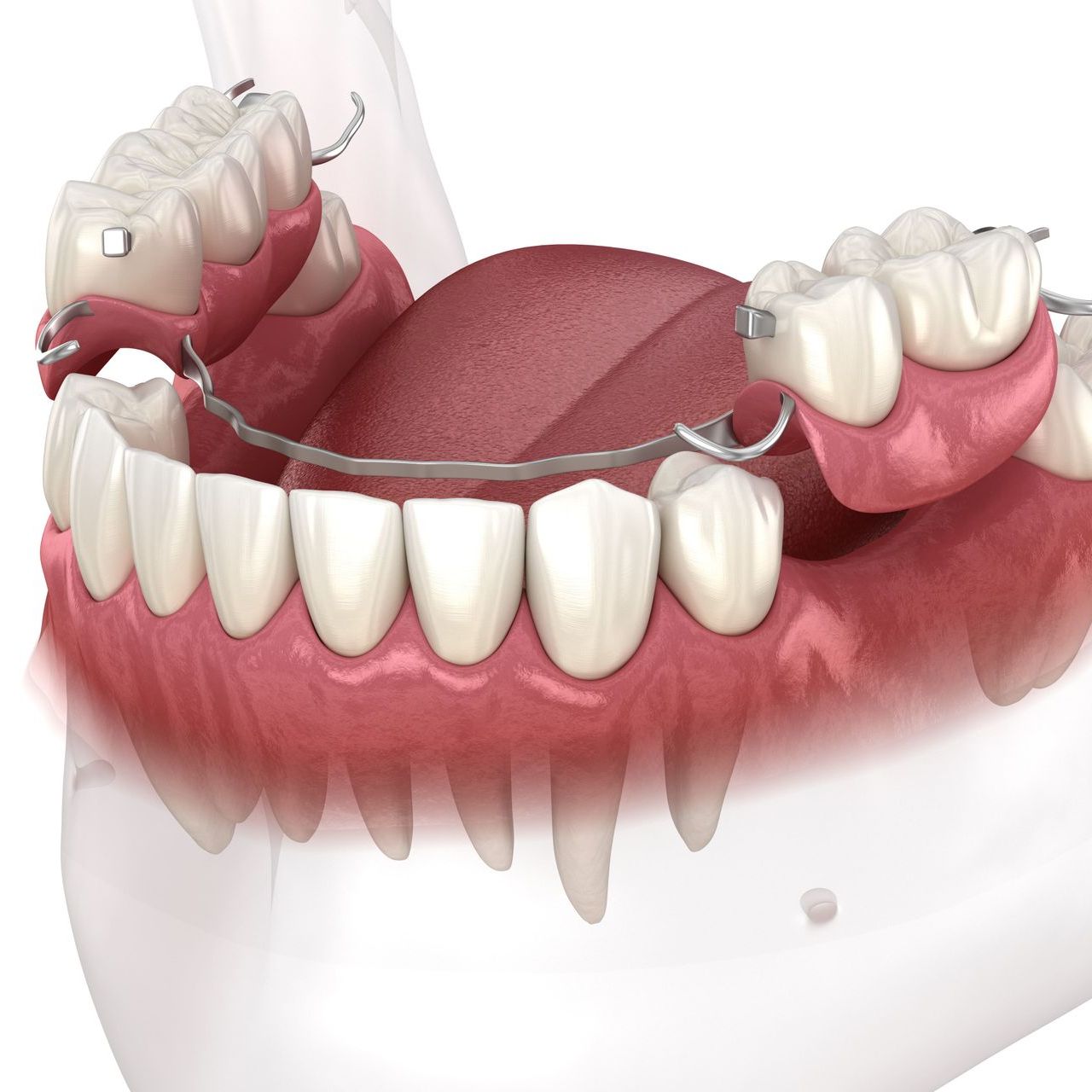 A computer generated image of a dental flipper being inserted in between the existing teeth