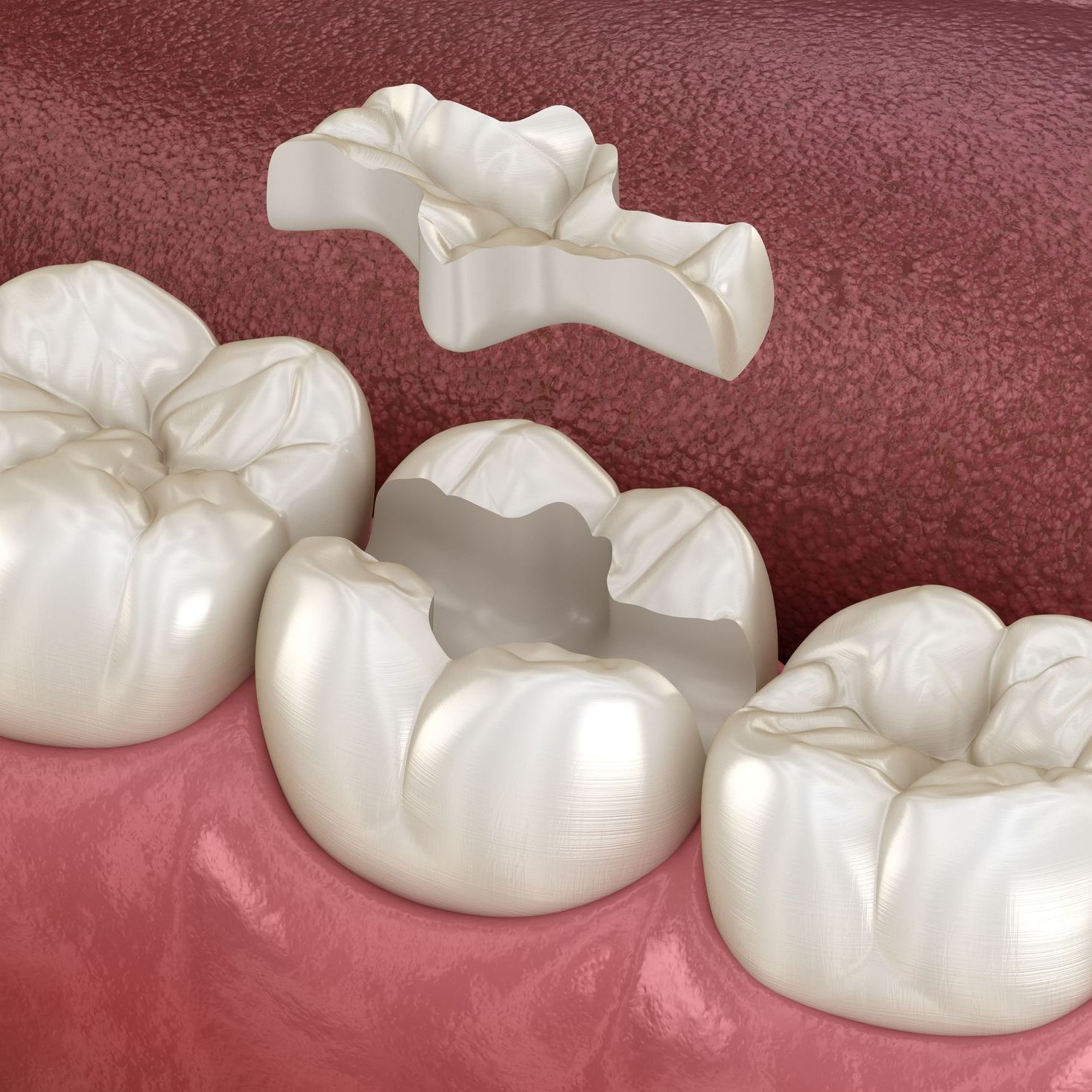 A computer generated image of a dental inlay being inserted into the tooth
