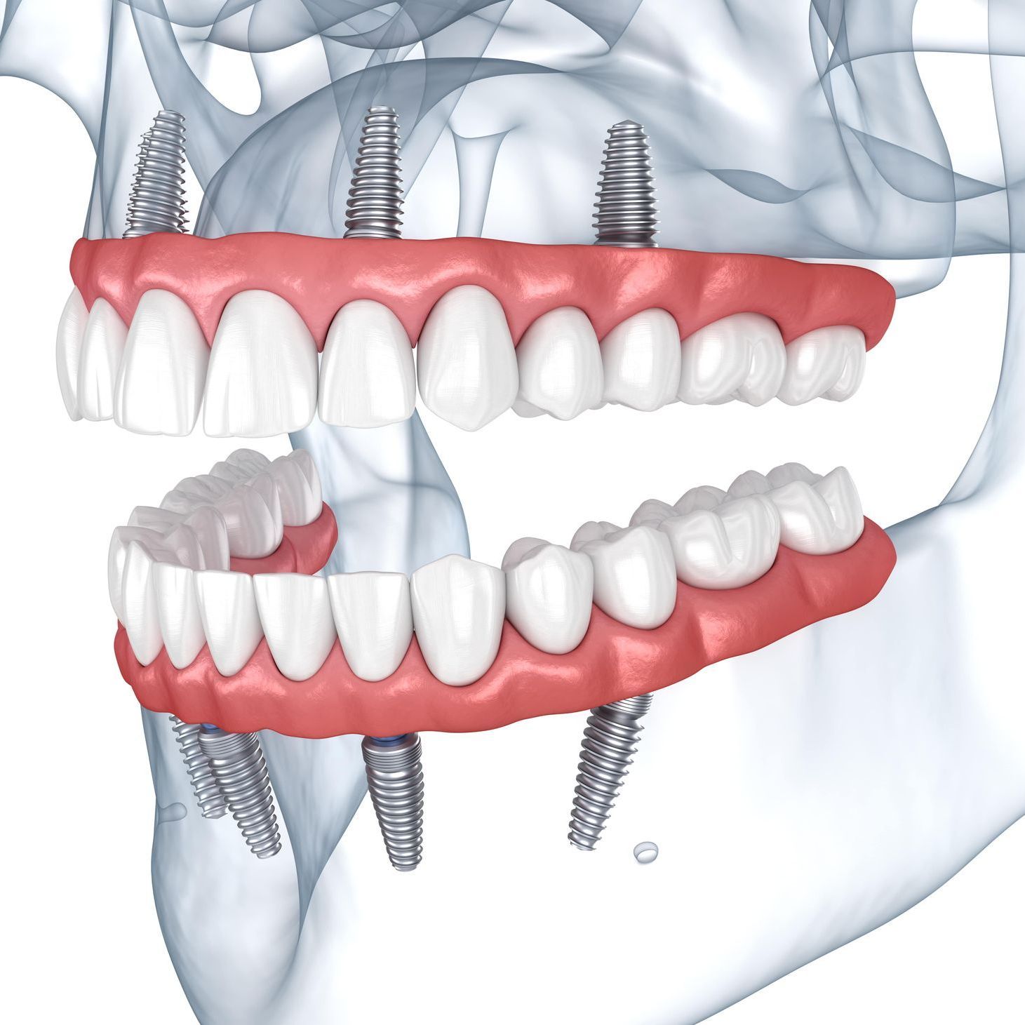 A computer generated image of a mouth reconstructed with upper and lower implants