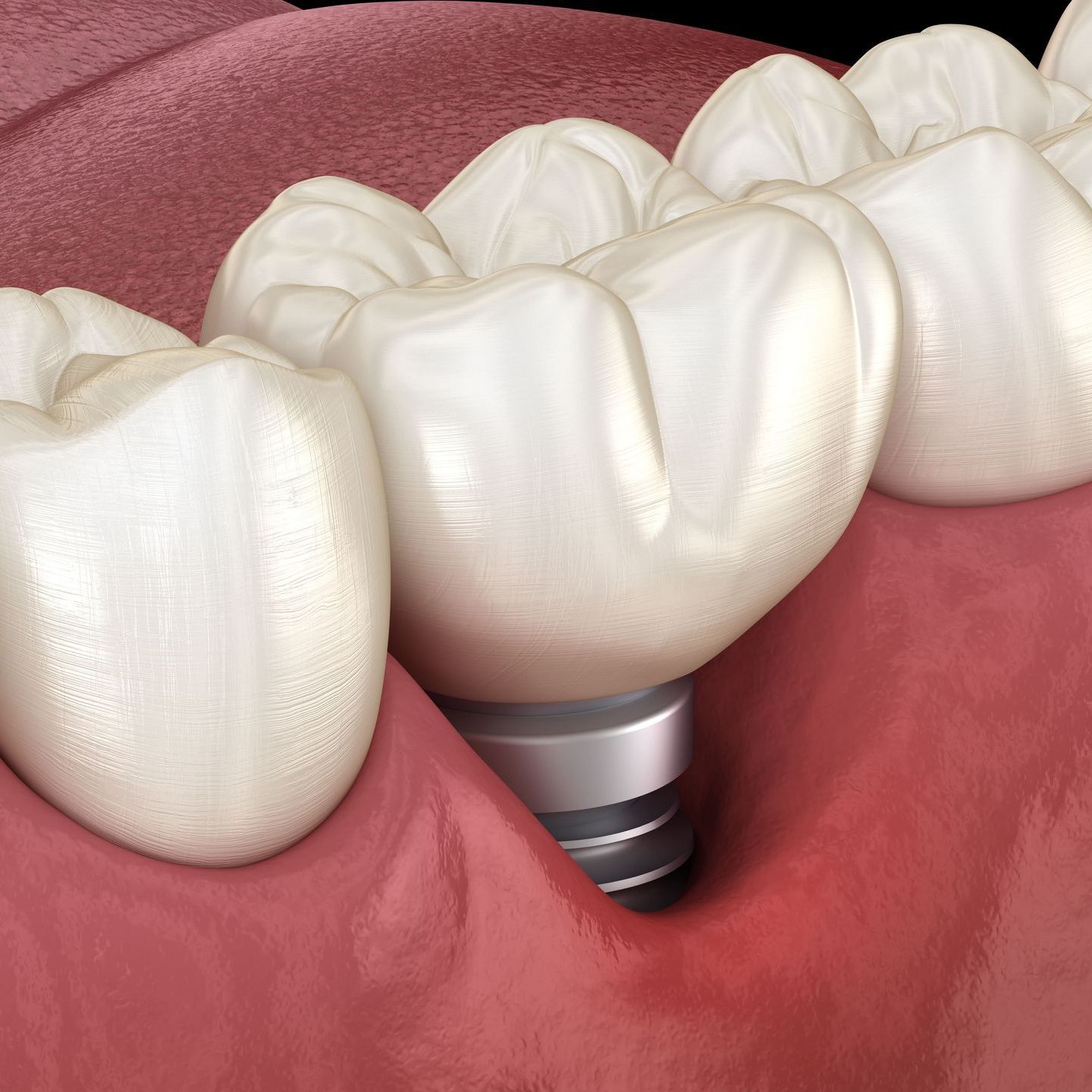 A computer generated image of a dental implant with a recessed gum