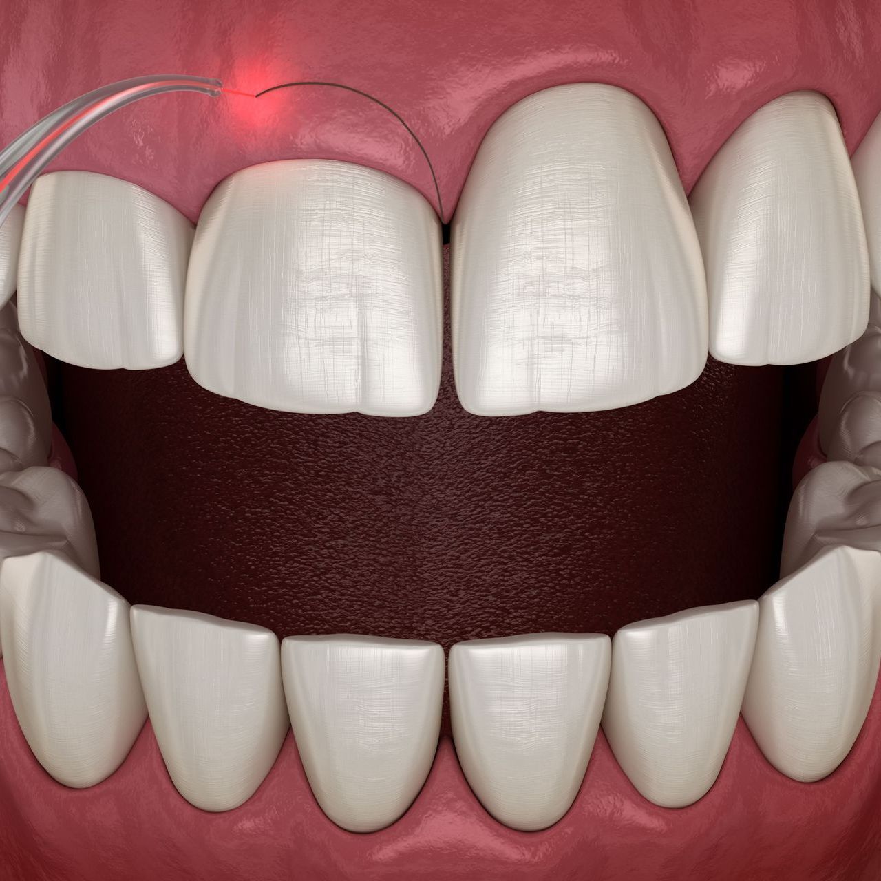 A computer generated image of gum tissue being removed with a laser