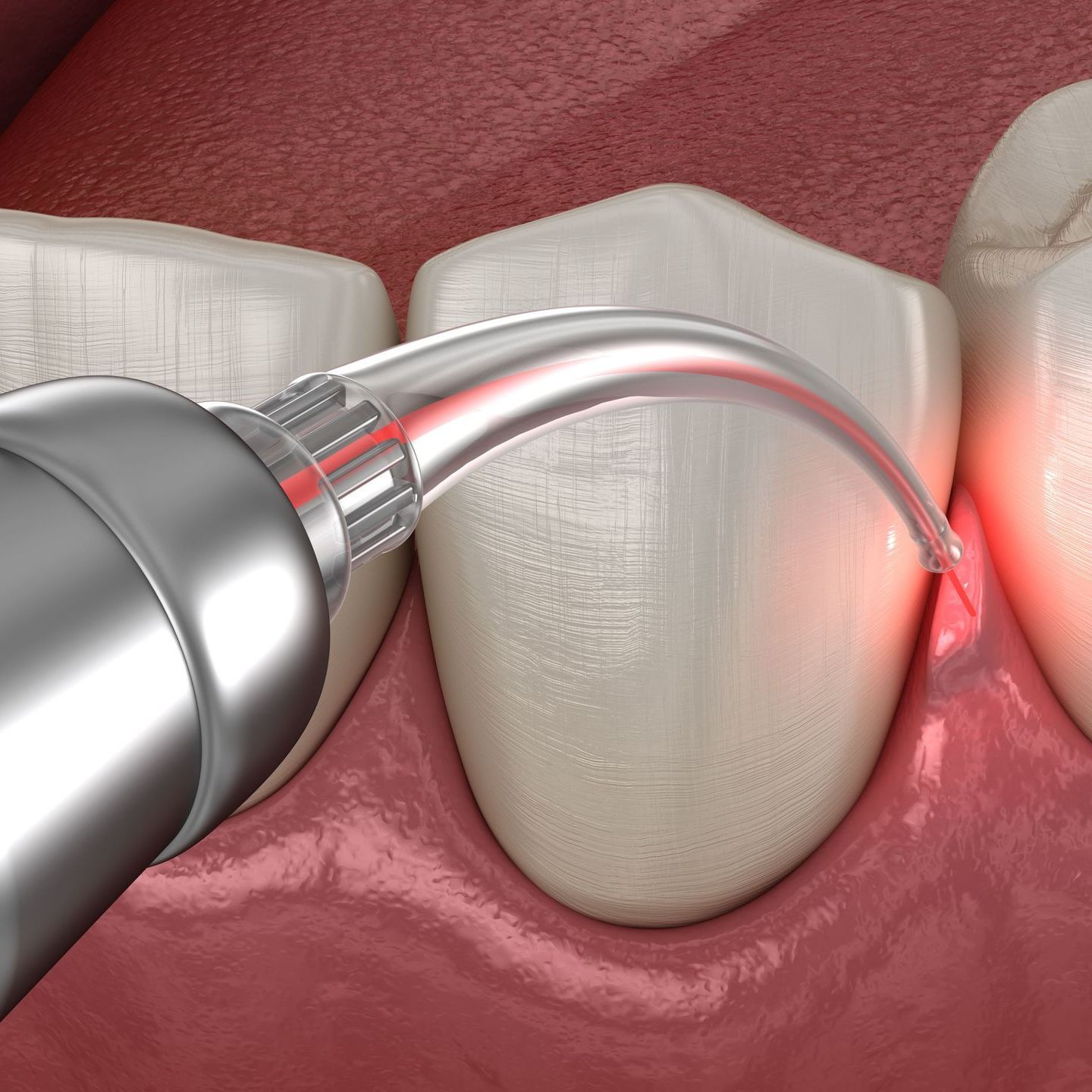 A computer generated image of laser gum treatment
