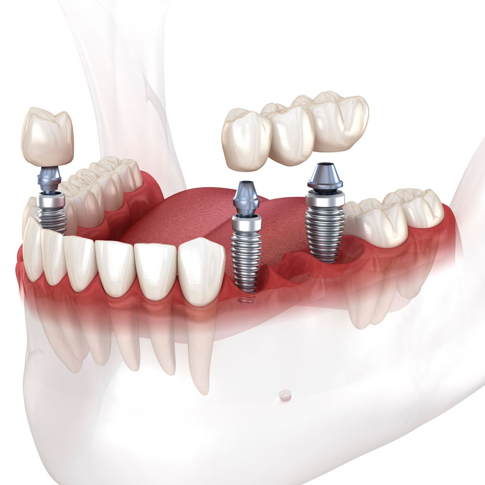A computer generated image showing multiple teeth being replaced with implants