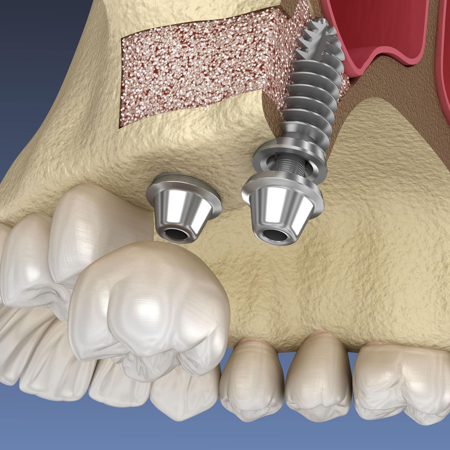 A computer generated image of two dental implants inserted into a filled sinus
