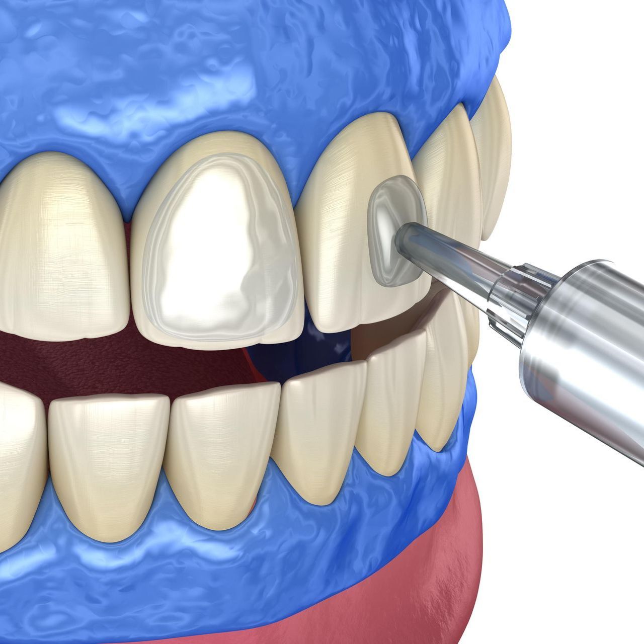 A computer generated image of whitening gel being applied to the teeth