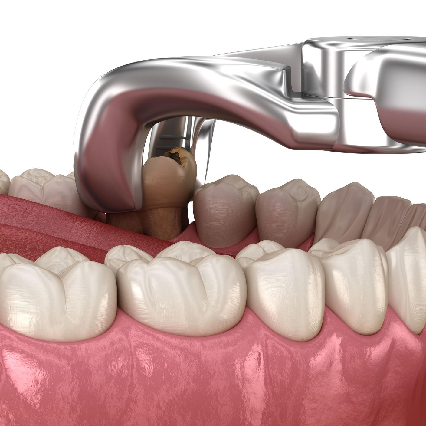 A computer generated image of a decayed tooth being extracted