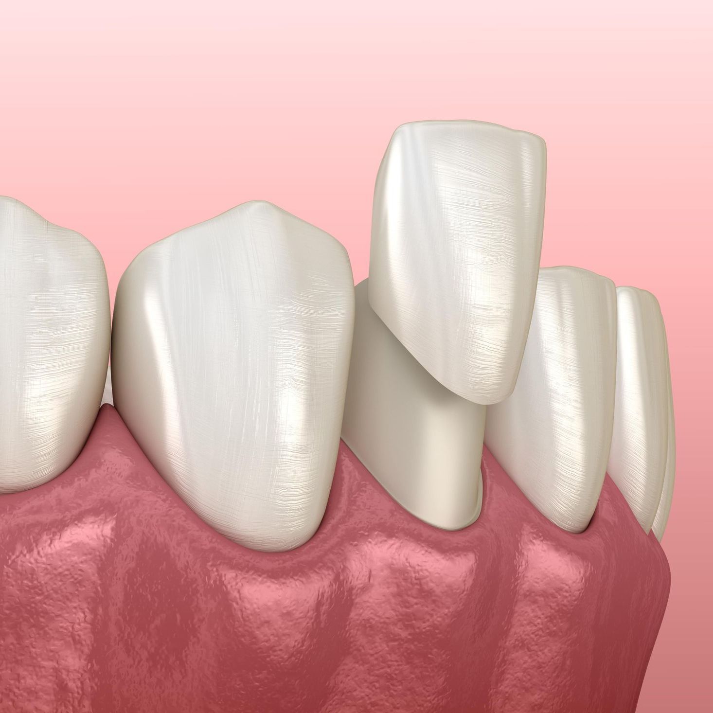 A computer generated image of a veneer being applied to a tooth