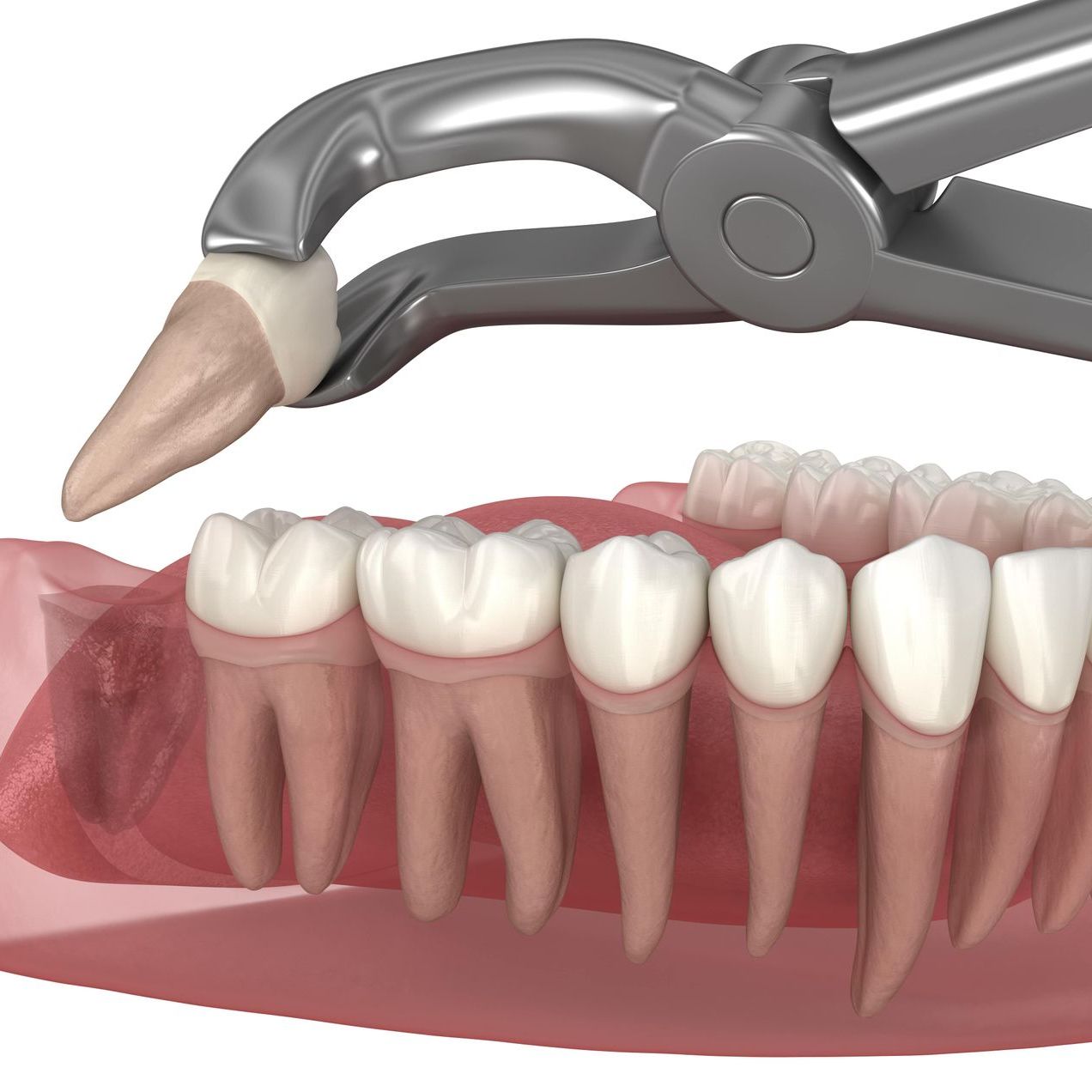 A computer generated image of a wisdom tooth being extracted