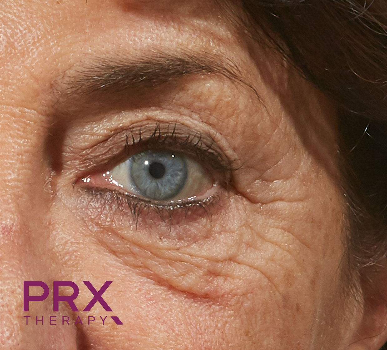 Eine Nahaufnahme eines Frauenauges mit dem PRX-Therapie-Logo in der Ecke