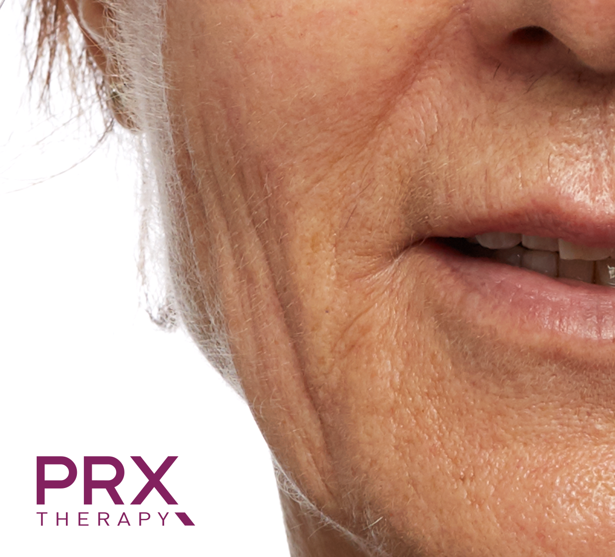 Eine Nahaufnahme eines Frauengesichts mit dem PRX-Therapie-Logo in der Ecke
