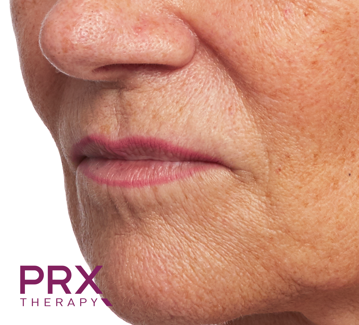 Eine Nahaufnahme eines Frauengesichts mit dem PRX-Therapie-Logo in der Ecke