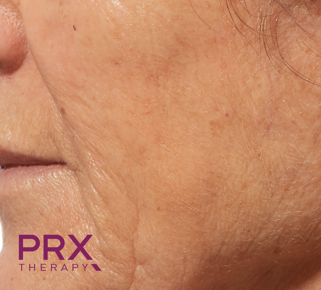 Eine Nahaufnahme des Gesichts einer Frau mit einem PRX-Therapie-Logo im Hintergrund.