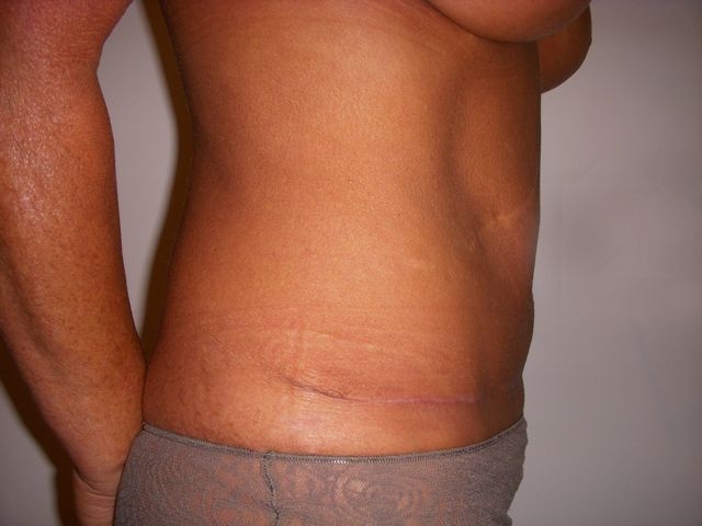 Body Procedure Gallery #2 After – North Charleston, SC – Palmetto Plastic Surgery