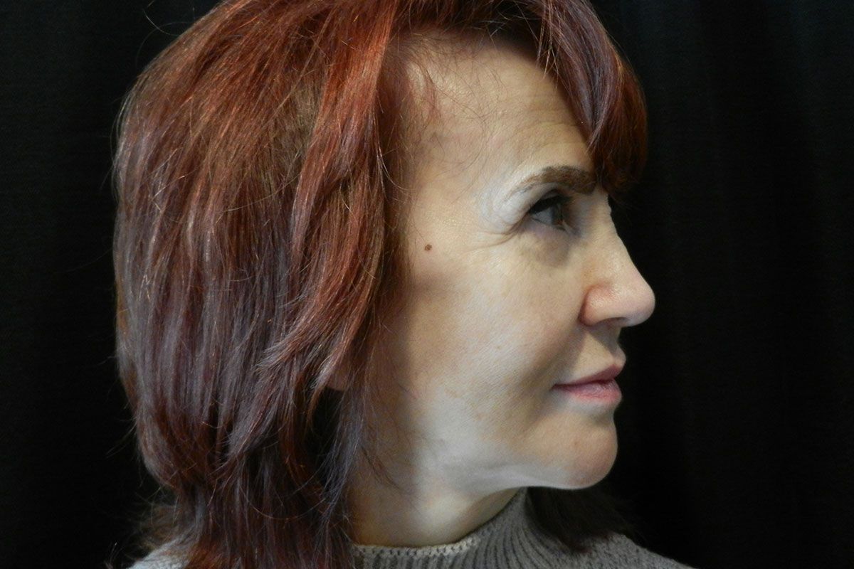 Facial Procedure Gallery #11 After – North Charleston, SC – Palmetto Plastic Surgery