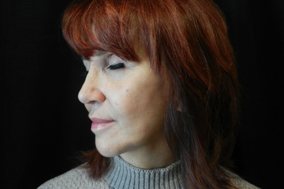 Facial Procedure Gallery #10 After – North Charleston, SC – Palmetto Plastic Surgery