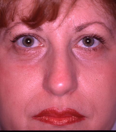 Facial Procedure Gallery #2 After – North Charleston, SC – Palmetto Plastic Surgery
