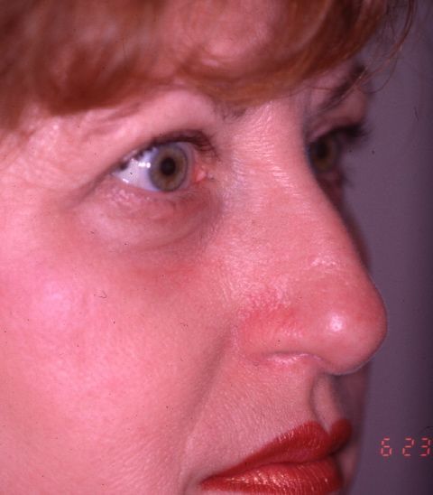 Facial Procedure Gallery #3 After – North Charleston, SC – Palmetto Plastic Surgery