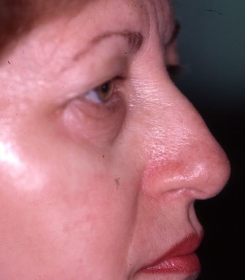 Facial Procedure Gallery #3 Before – North Charleston, SC – Palmetto Plastic Surgery
