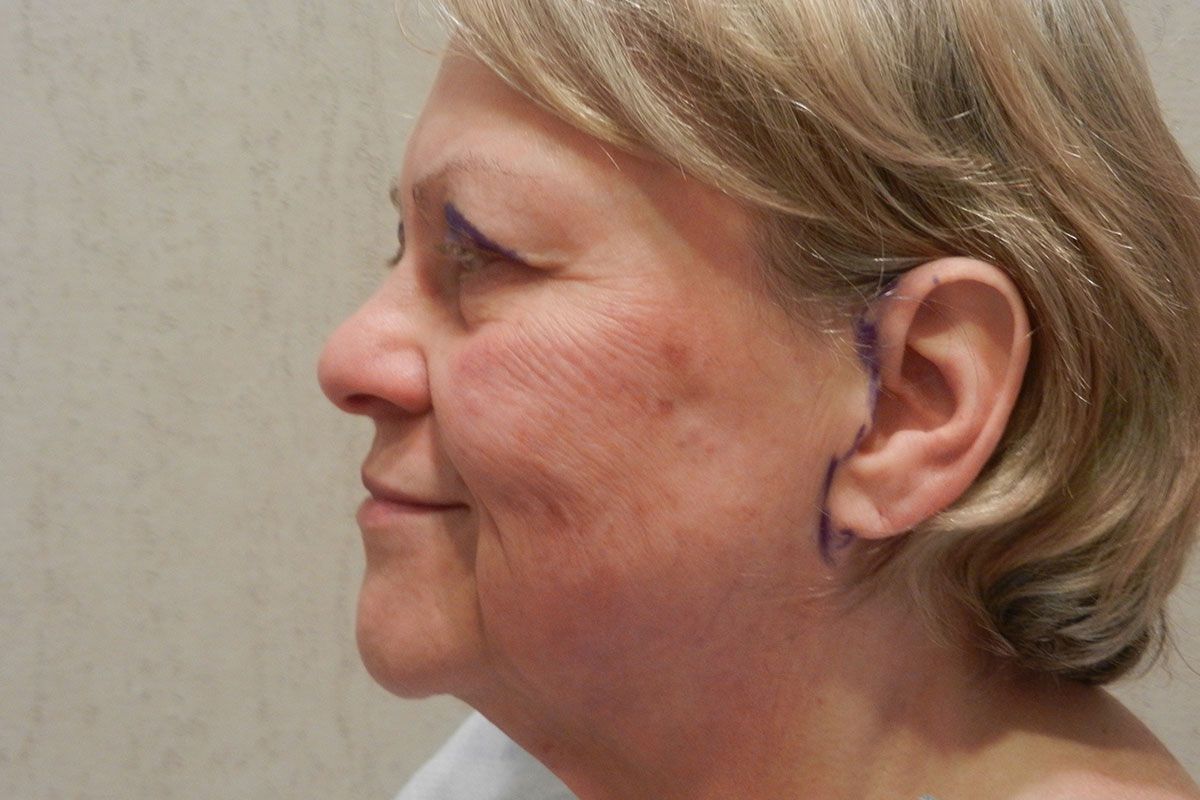 Facial Procedure Gallery #16 Before – North Charleston, SC – Palmetto Plastic Surgery