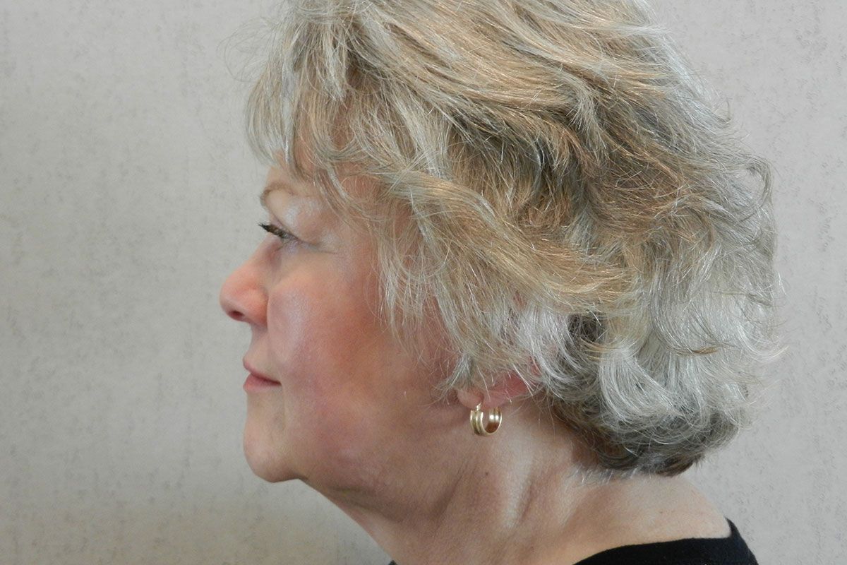 Facial Procedure Gallery #16 After – North Charleston, SC – Palmetto Plastic Surgery