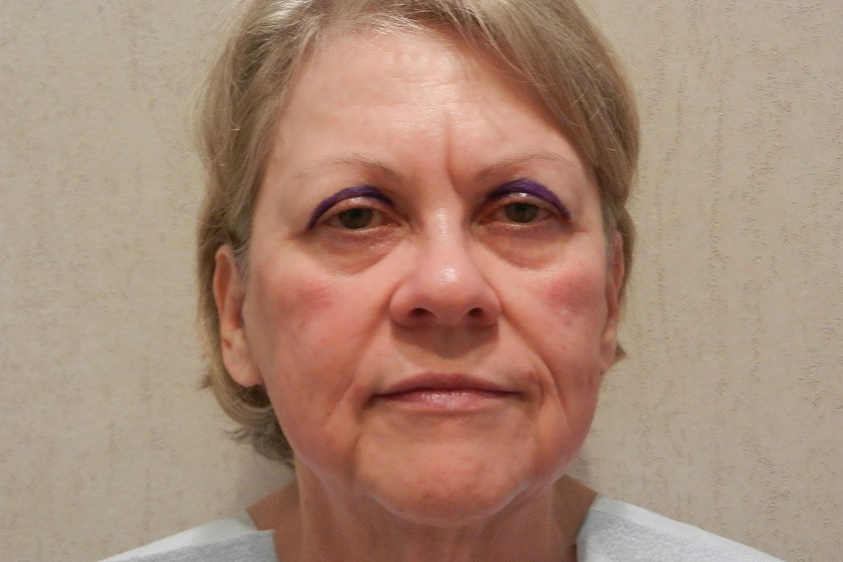 Facial Procedure Gallery #15 Before – North Charleston, SC – Palmetto Plastic Surgery