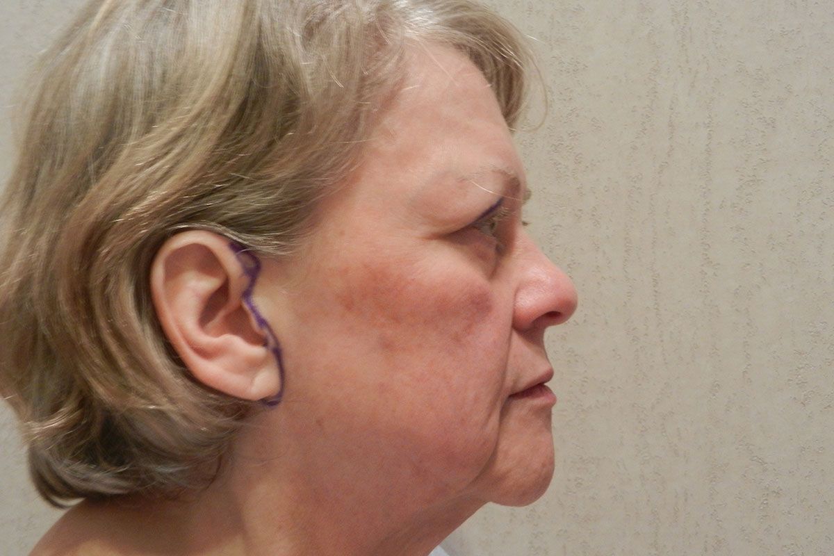 Facial Procedure Gallery #17 Before – North Charleston, SC – Palmetto Plastic Surgery