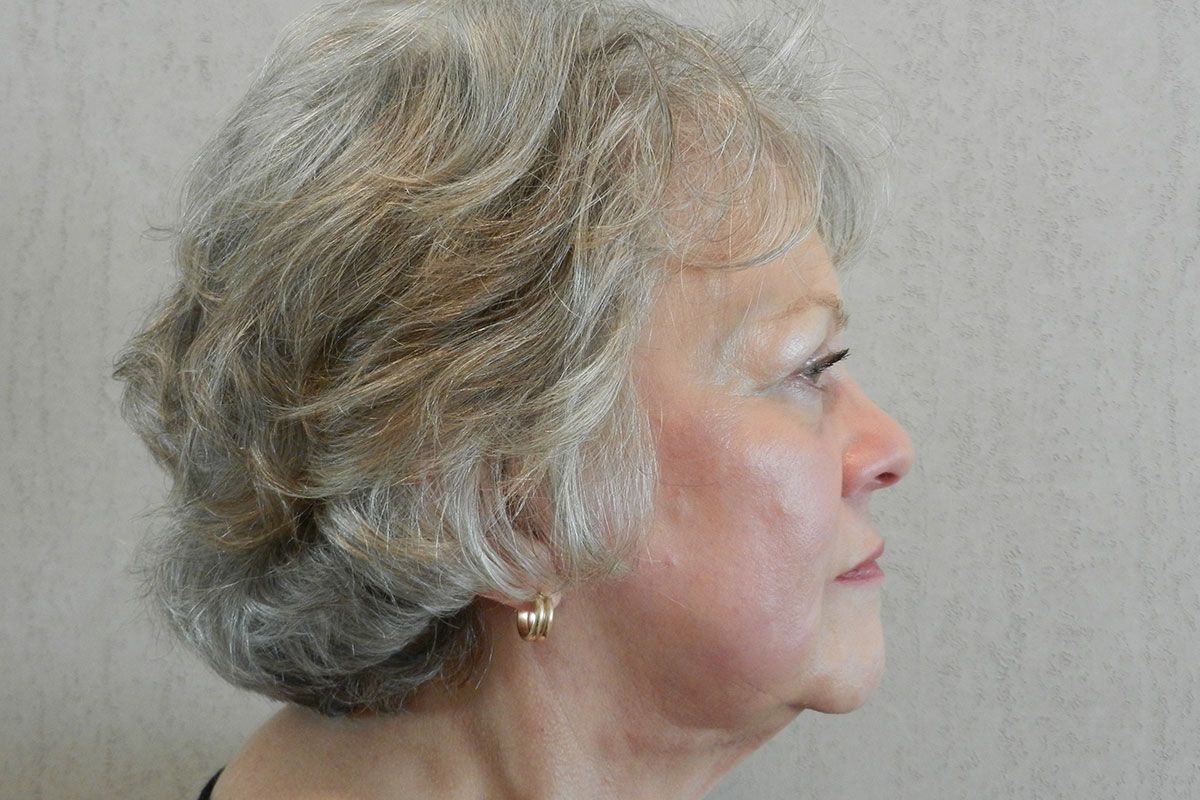 Facial Procedure Gallery #17 After – North Charleston, SC – Palmetto Plastic Surgery