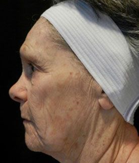Laser Procedure Gallery #2 Before – North Charleston, SC – Palmetto Plastic Surgery