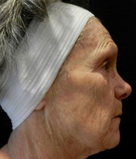 Laser Procedure Gallery #3 Before – North Charleston, SC – Palmetto Plastic Surgery