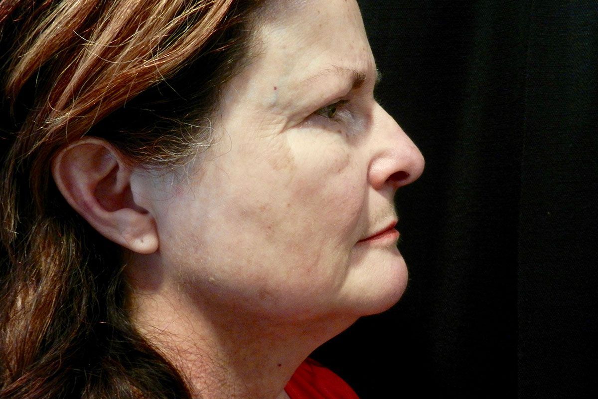 Facial Procedure Gallery #14 Before – North Charleston, SC – Palmetto Plastic Surgery
