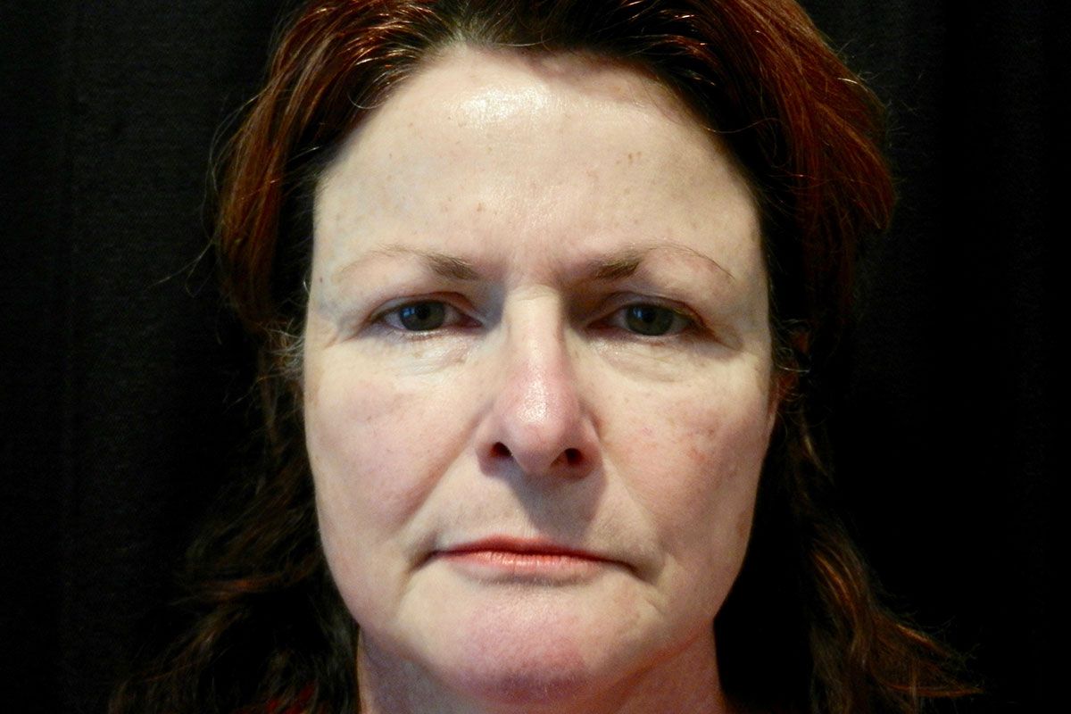Facial Procedure Gallery #12 Before – North Charleston, SC – Palmetto Plastic Surgery