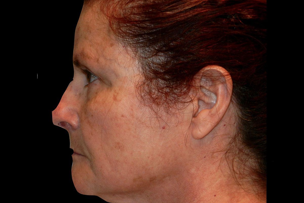 Facial Procedure Gallery #13 After – North Charleston, SC – Palmetto Plastic Surgery