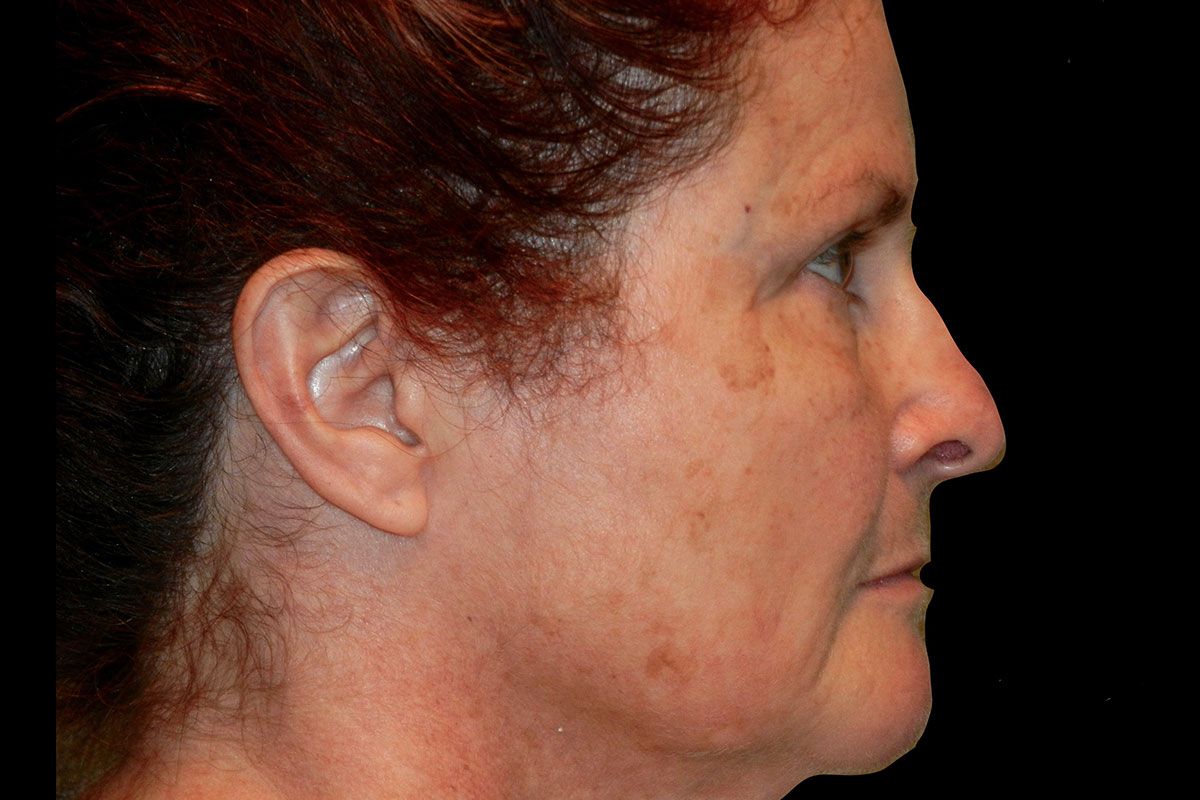 Facial Procedure Gallery #14 After – North Charleston, SC – Palmetto Plastic Surgery