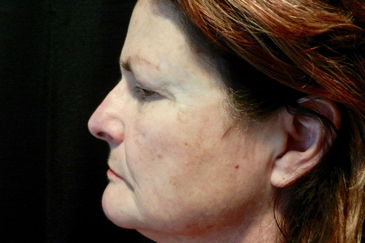 Facial Procedure Gallery #13 Before – North Charleston, SC – Palmetto Plastic Surgery