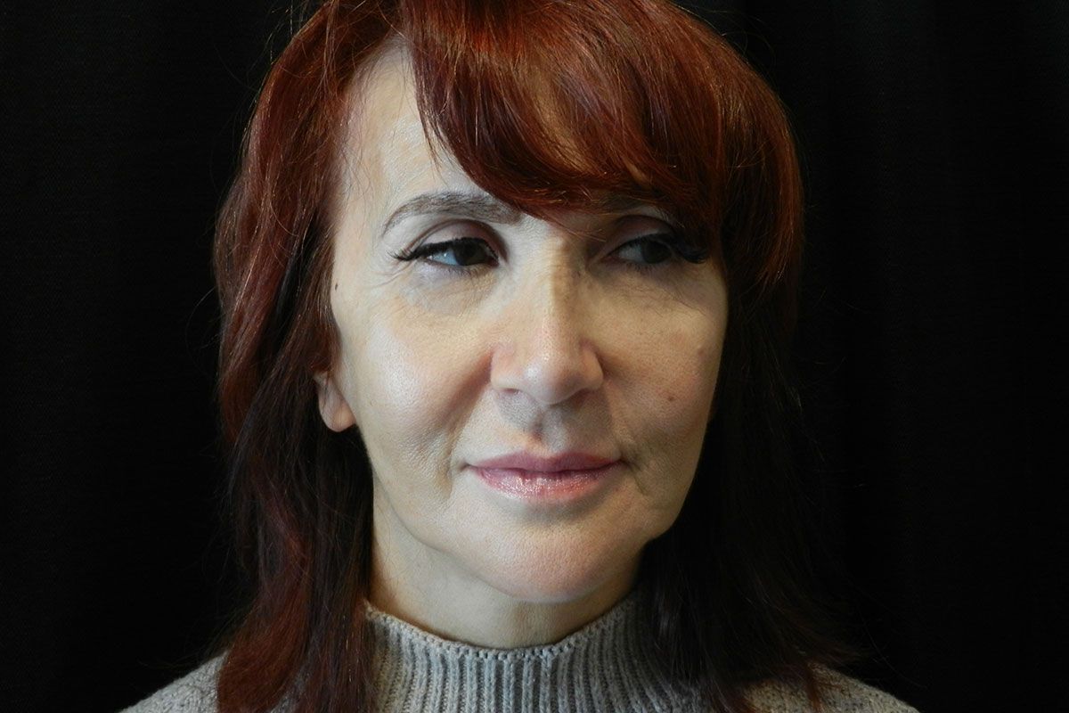 Facial Procedure Gallery #9 After – North Charleston, SC – Palmetto Plastic Surgery